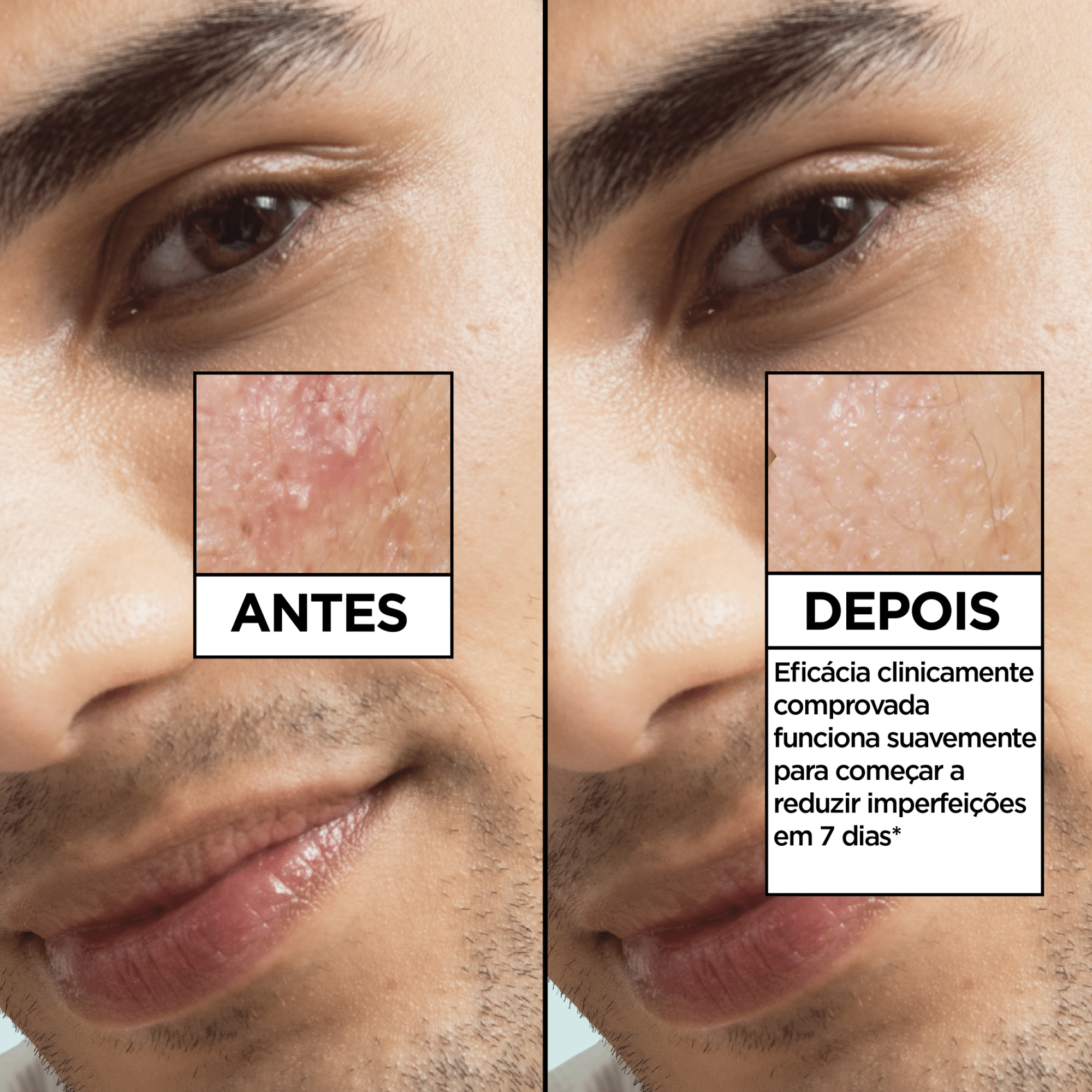 S&eacute;rum de Rosto Anti-Imperfei&ccedil;&otilde;es Garnier Skin Active