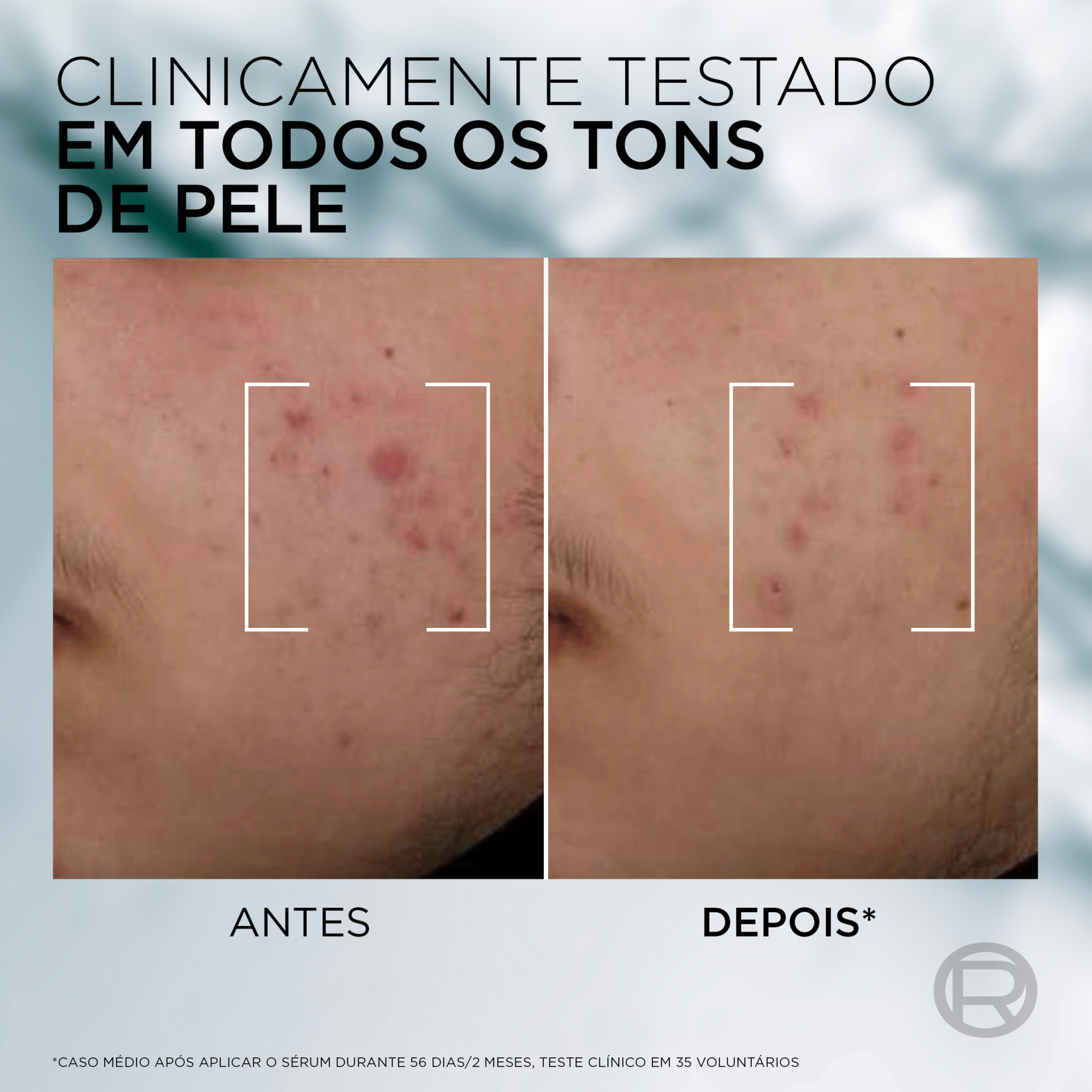 S&eacute;rum de Rosto Derma Control Anti-Imperfei&ccedil;&otilde;es L'Or&eacute;al Paris Men Expert