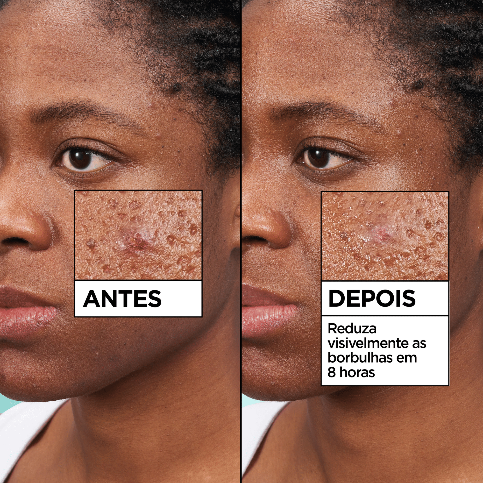 Adesivos Faciais Borbulhas Garnier Skin Active