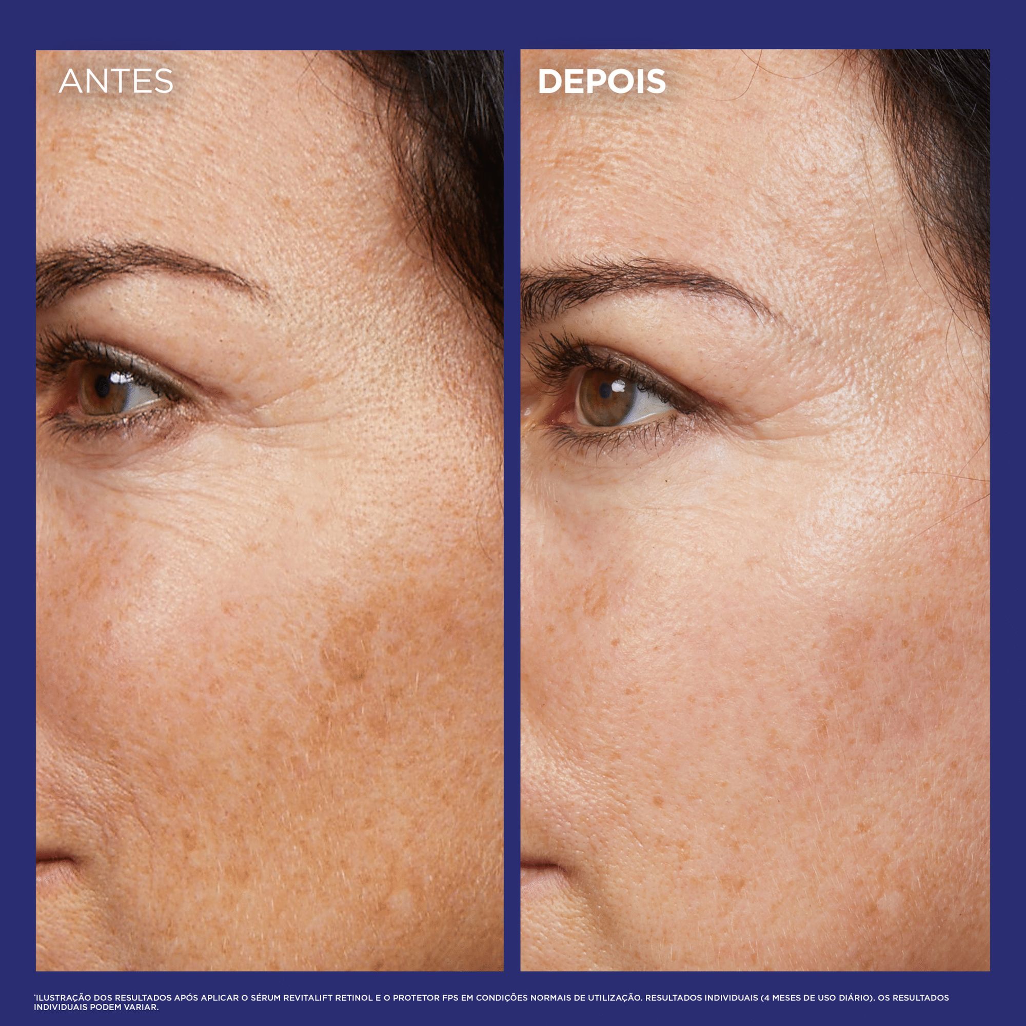 S&eacute;rum Facial Noite Revitalift Laser L'Or&eacute;al Paris
