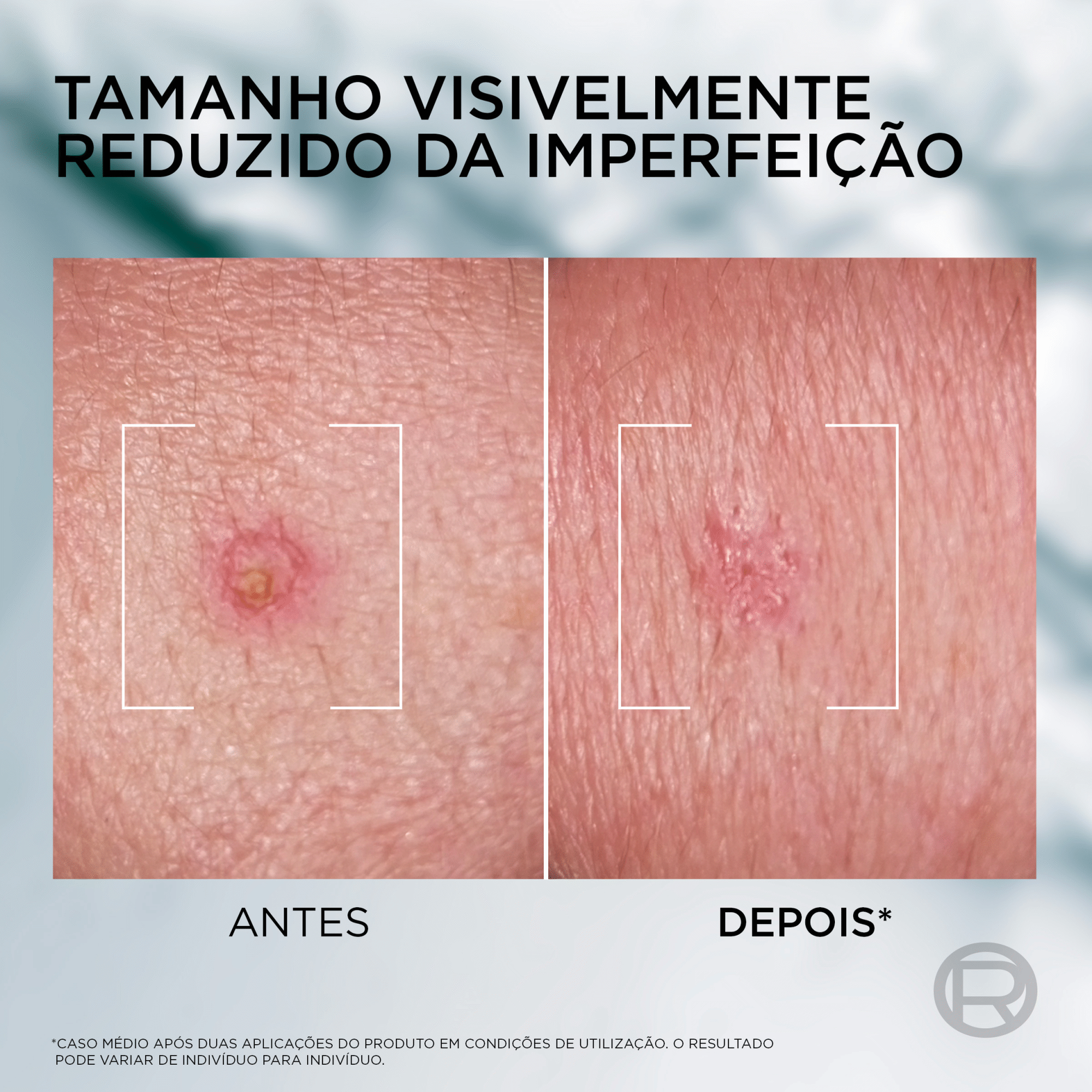 Creme de Rosto Derma Control SOS Pimple Paste L'Or&eacute;al Paris Men Expert